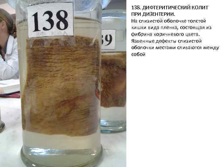 138. ДИФТЕРИТИЧЕСКИЙ КОЛИТ ПРИ ДИЗЕНТЕРИИ. На слизистой оболочке толстой кишки вида пленка, состоящая из