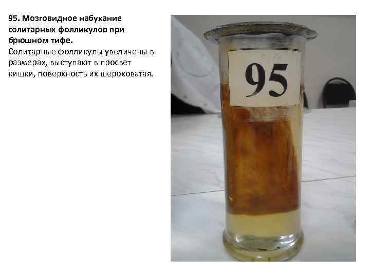 95. Мозговидное набухание солитарных фолликулов при брюшном тифе. Солитарные фолликулы увеличены в размерах, выступают