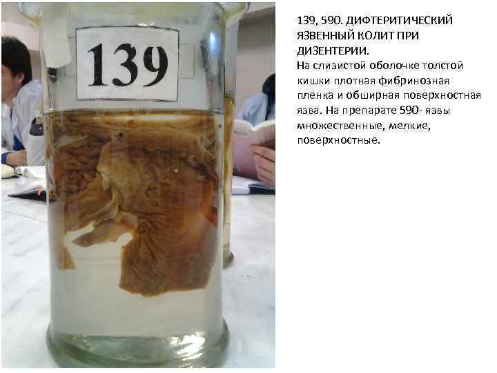 139, 590. ДИФТЕРИТИЧЕСКИЙ ЯЗВЕННЫЙ КОЛИТ ПРИ ДИЗЕНТЕРИИ. На слизистой оболочке толстой кишки плотная фибринозная