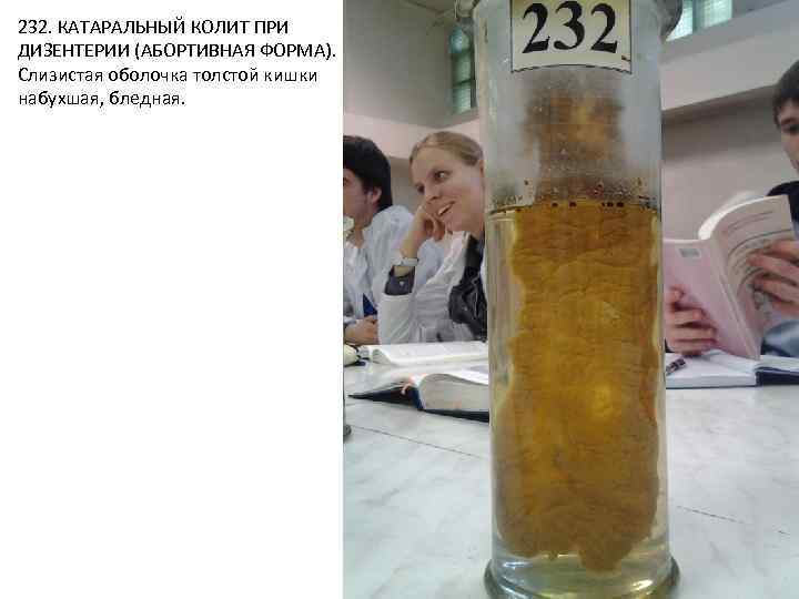 232. КАТАРАЛЬНЫЙ КОЛИТ ПРИ ДИЗЕНТЕРИИ (АБОРТИВНАЯ ФОРМА). Слизистая оболочка толстой кишки набухшая, бледная. 