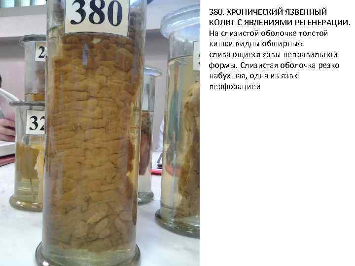 380. ХРОНИЧЕСКИЙ ЯЗВЕННЫЙ КОЛИТ С ЯВЛЕНИЯМИ РЕГЕНЕРАЦИИ. На слизистой оболочке толстой кишки видны обширные