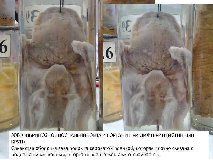 308. ФИБРИНОЗНОЕ ВОСПАЛЕНИЕ ЗЕВА И ГОРТАНИ ПРИ ДИФТЕРИИ (ИСТИННЫЙ КРУП). Слизистая оболочка зева покрыта