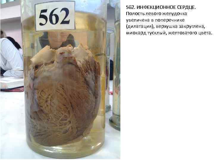 562. ИНФЕКЦИОННОЕ СЕРДЦЕ. Полость левого желудочка увеличена в поперечнике (дилатация), верхушка закруглена, миокард тусклый,