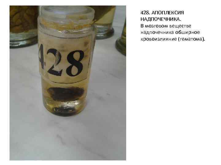 428. АПОПЛЕКСИЯ НАДПОЧЕЧНИКА. В мозговом веществе надпочечника обширное кровоизлияние (гематома). 