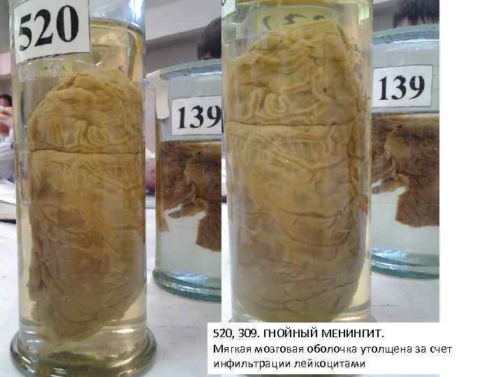 520, 309. ГНОЙНЫЙ МЕНИНГИТ. Мягкая мозговая оболочка утолщена за счет инфильтрации лейкоцитами 