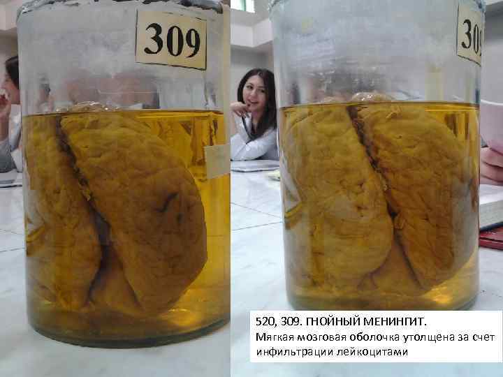 520, 309. ГНОЙНЫЙ МЕНИНГИТ. Мягкая мозговая оболочка утолщена за счет инфильтрации лейкоцитами 