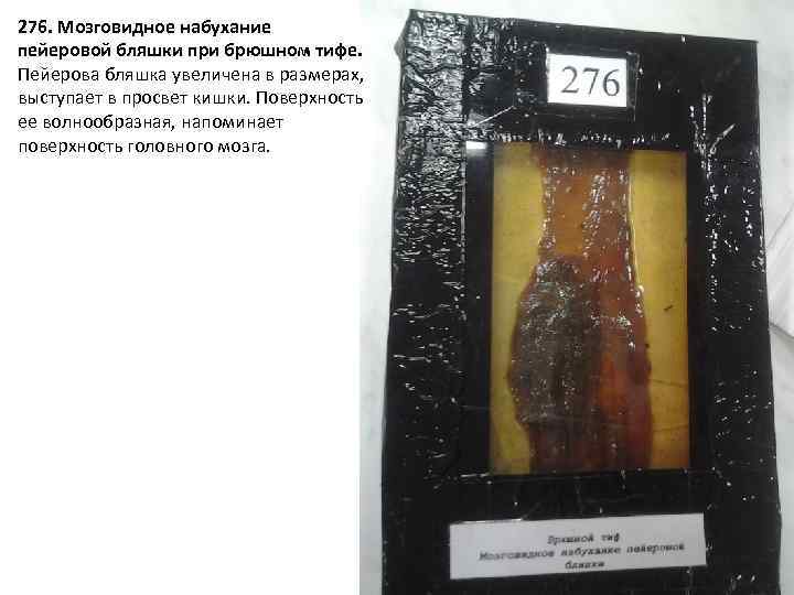 276. Мозговидное набухание пейеровой бляшки при брюшном тифе. Пейерова бляшка увеличена в размерах, выступает
