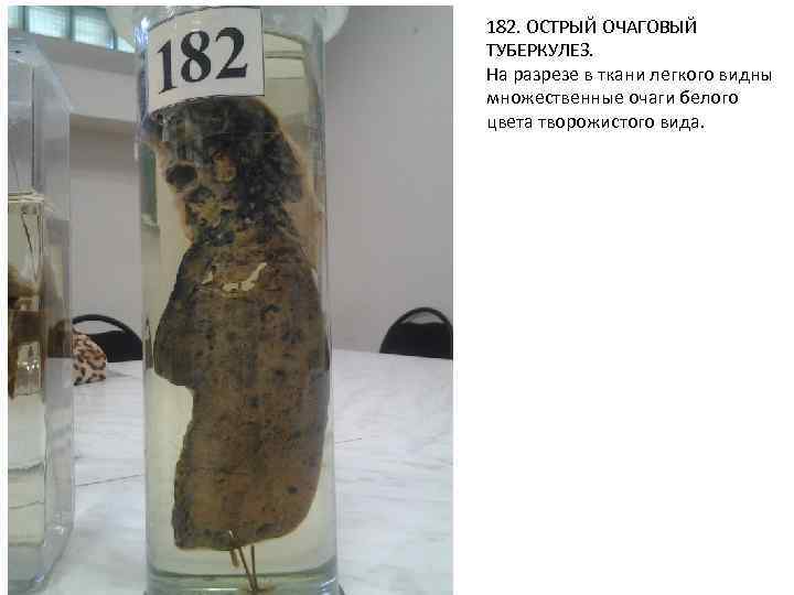 182. ОСТРЫЙ ОЧАГОВЫЙ ТУБЕРКУЛЕЗ. На разрезе в ткани легкого видны множественные очаги белого цвета