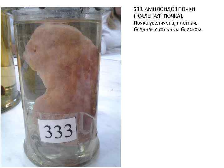 333. АМИЛОИДОЗ ПОЧКИ (“САЛЬНАЯ” ПОЧКА). Почка увеличена, плотная, бледная с сальным блеском. 