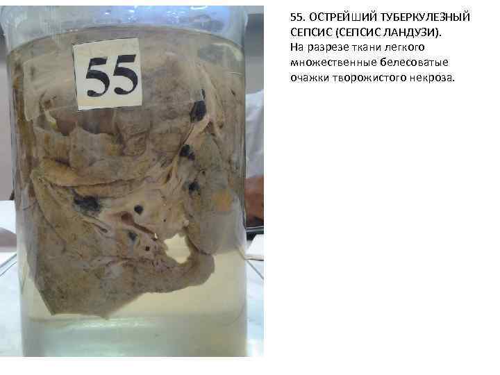 55. ОСТРЕЙШИЙ ТУБЕРКУЛЕЗНЫЙ СЕПСИС (СЕПСИС ЛАНДУЗИ). На разрезе ткани легкого множественные белесоватые очажки творожистого