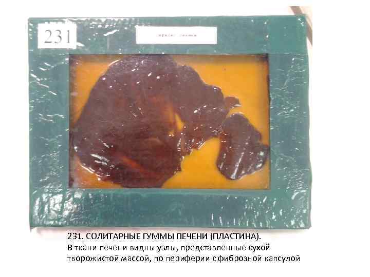 231. СОЛИТАРНЫЕ ГУММЫ ПЕЧЕНИ (ПЛАСТИНА). В ткани печени видны узлы, представленные сухой творожистой массой,