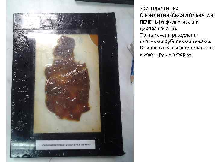 237. ПЛАСТИНКА. СИФИЛИТИЧЕСКАЯ ДОЛЬЧАТАЯ ПЕЧЕНЬ (сифилитический цирроз печени). Ткань печени разделена плотными рубцовыми тяжами.