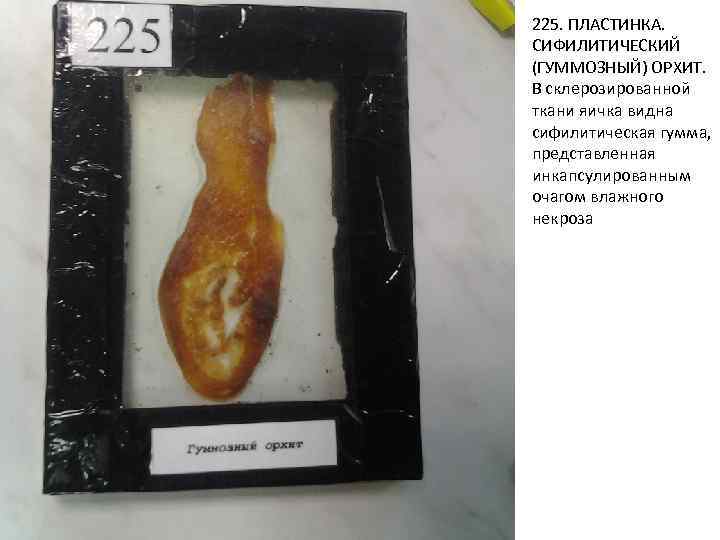 225. ПЛАСТИНКА. СИФИЛИТИЧЕСКИЙ (ГУММОЗНЫЙ) ОРХИТ. В склерозированной ткани яичка видна сифилитическая гумма, представленная инкапсулированным