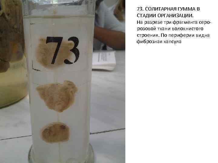 73. СОЛИТАРНАЯ ГУММА В СТАДИИ ОРГАНИЗАЦИИ. На разрезе три фрагмента серорозовой ткани волокнистого строения.