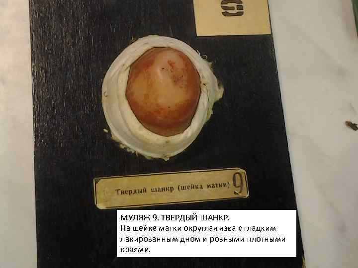 МУЛЯЖ 9. ТВЕРДЫЙ ШАНКР. На шейке матки округлая язва с гладким лакированным дном и