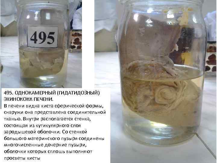 495. ОДНОКАМЕРНЫЙ (ГИДАТИДОЗНЫЙ) ЭХИНОКОКК ПЕЧЕНИ. В печени видна киста сферической формы, снаружи она представлена