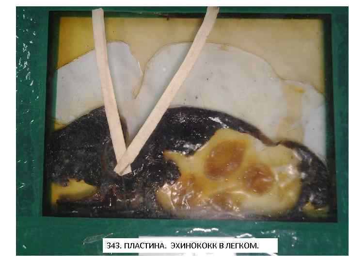 343. ПЛАСТИНА. ЭХИНОКОКК В ЛЕГКОМ. 