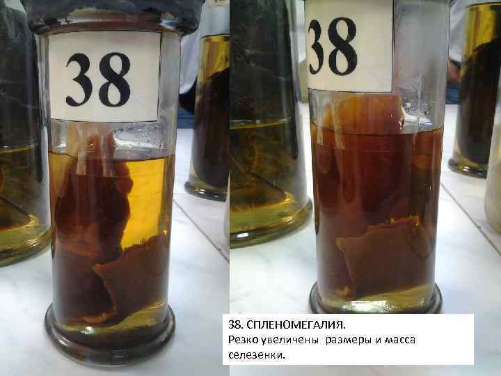 38. СПЛЕНОМЕГАЛИЯ. Резко увеличены размеры и масса селезенки. 
