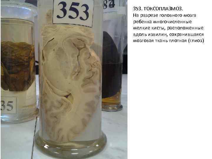 353. ТОКСОПЛАЗМОЗ. На разрезе головного мозга ребенка многочисленные мелкие кисты, расположенные вдоль извилин, сохранившаяся