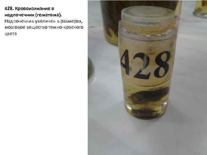 428. Кровоизлияние в надпочечник (гематома). Надпочечник увеличен в размерах, мозговое вещество темно-красного цвета 