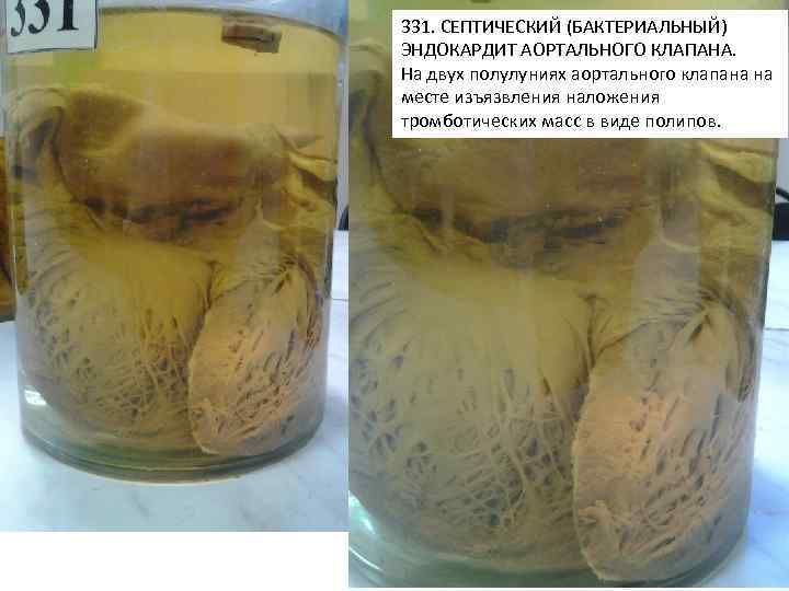 331. СЕПТИЧЕСКИЙ (БАКТЕРИАЛЬНЫЙ) ЭНДОКАРДИТ АОРТАЛЬНОГО КЛАПАНА. На двух полулуниях аортального клапана на месте изъязвления