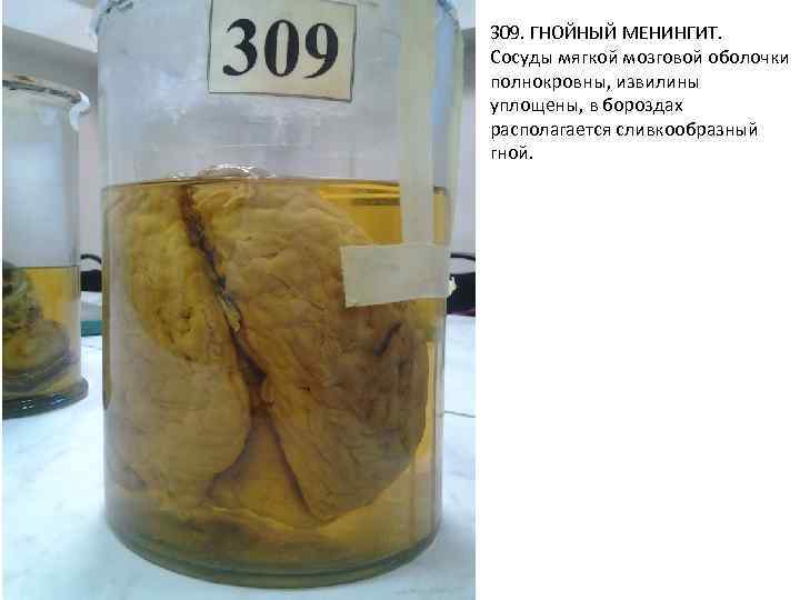 309. ГНОЙНЫЙ МЕНИНГИТ. Сосуды мягкой мозговой оболочки полнокровны, извилины уплощены, в бороздах располагается сливкообразный