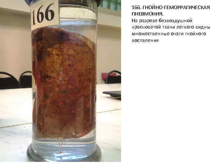 166. ГНОЙНО-ГЕМОРРАГИЧЕСКАЯ ПНЕВМОНИЯ. На разрезе безвоздушной красноватой ткани легкого видны множественные очаги гнойного воспаления