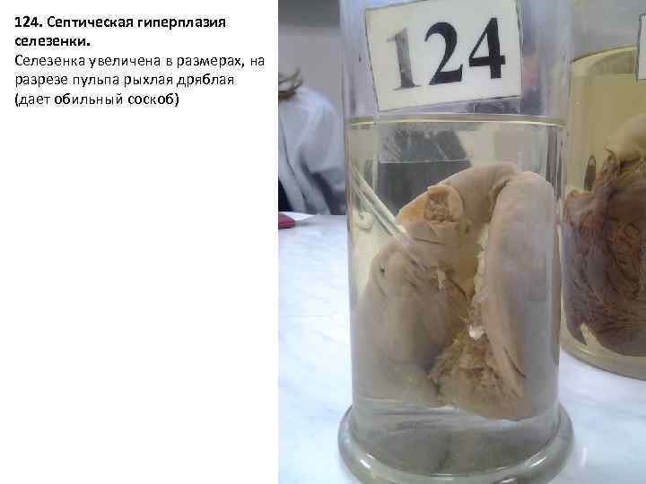 124. Септическая гиперплазия селезенки. Селезенка увеличена в размерах, на разрезе пульпа рыхлая дряблая (дает