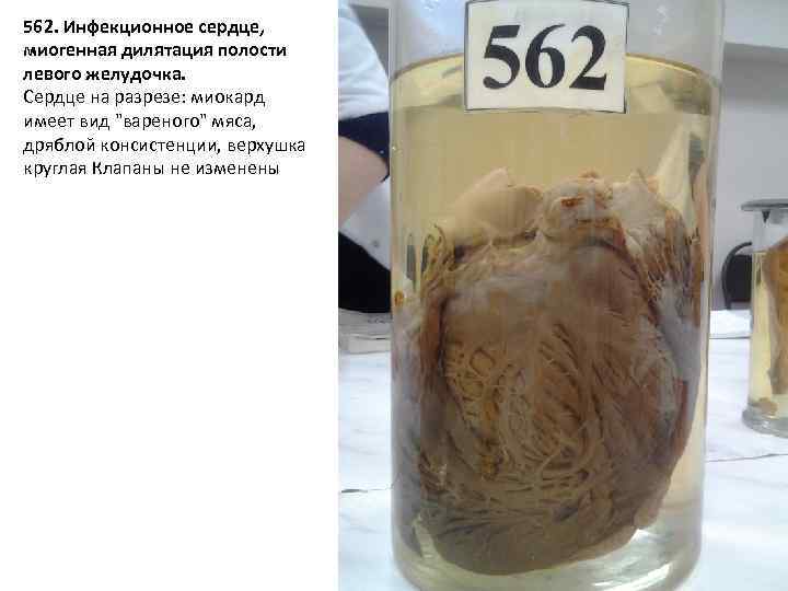 562. Инфекционное сердце, миогенная дилятация полости левого желудочка. Сердце на разрезе: миокард имеет вид