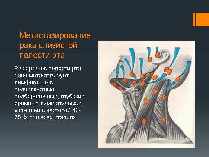 Метастазирование рака слизистой полости рта Рак органов полости рта рано метастазирует лимфогенно в подчелюстные,