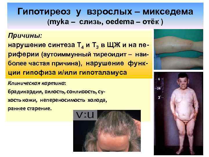 Гипотиреоз у взрослых – микседема (myka – слизь, oedema – отёк ) Причины: нарушение