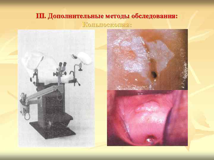 III. Дополнительные методы обследования: Кольпоскопия: 
