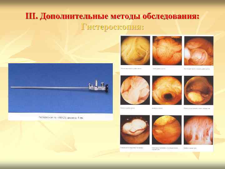 III. Дополнительные методы обследования: Гистероскопия: 
