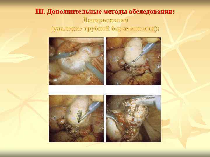 III. Дополнительные методы обследования: Лапароскопия (удаление трубной беременности): 