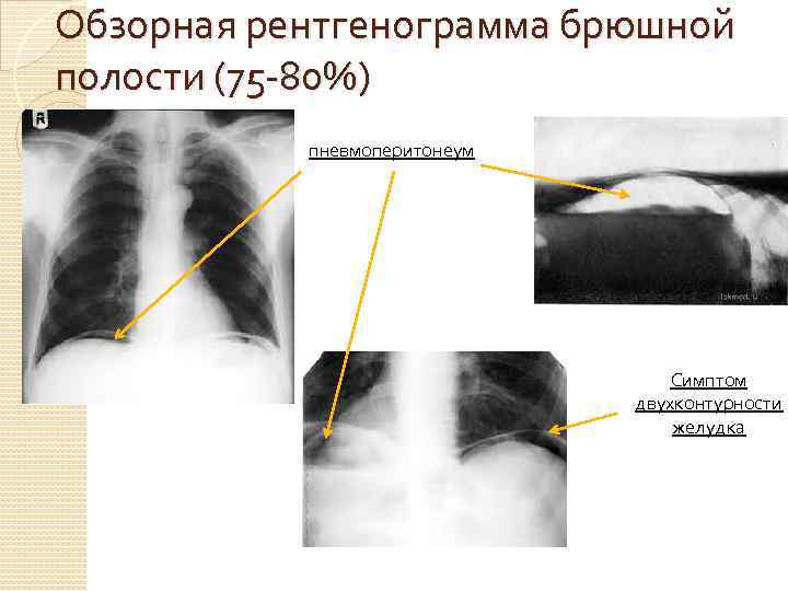 Обзорная рентгенограмма брюшной полости (75 -80%) пневмоперитонеум Симптом двухконтурности желудка 