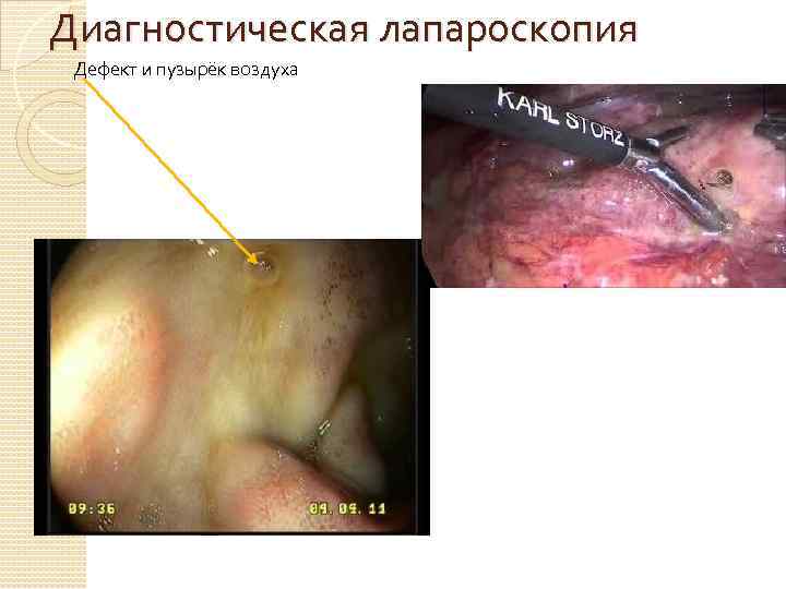 Диагностическая лапароскопия Дефект и пузырёк воздуха 
