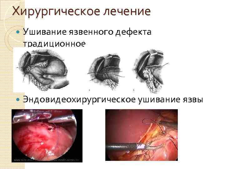 Хирургическое лечение Ушивание язвенного дефекта традиционное Эндовидеохирургическое ушивание язвы 