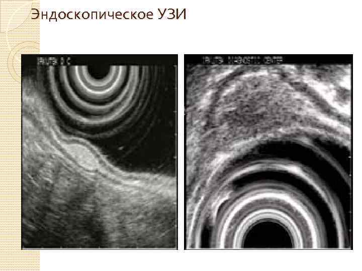 Эндоскопическое УЗИ 