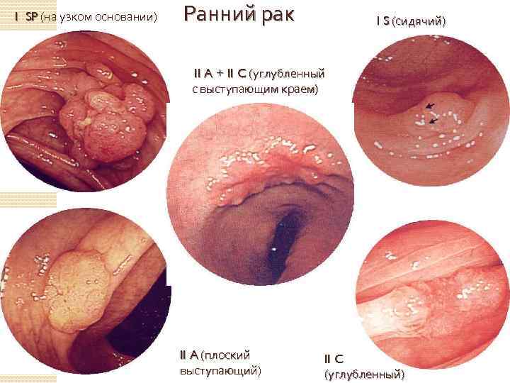 I SP (на узком основании) Ранний рак I S (сидячий) II A + II