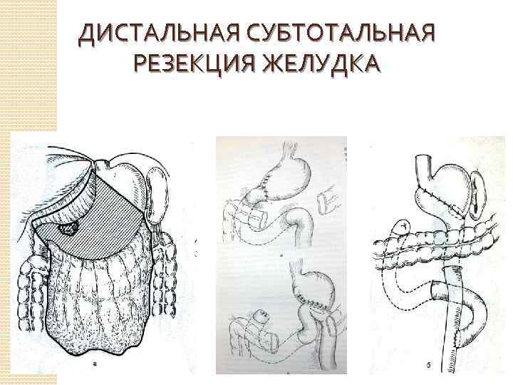 Гастрэктомия по сигалу схема