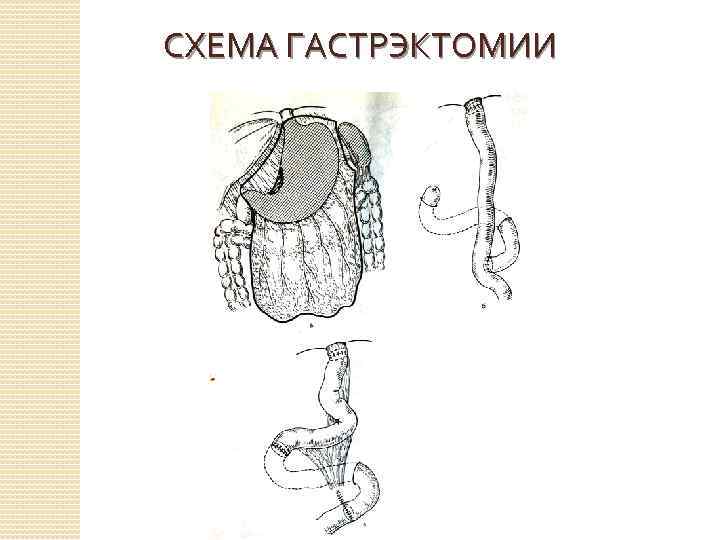 СХЕМА ГАСТРЭКТОМИИ 