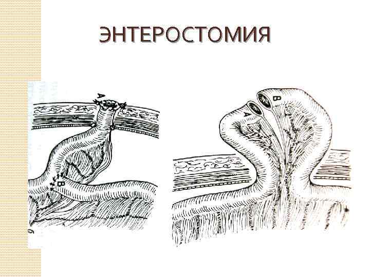 ЭНТЕРОСТОМИЯ 
