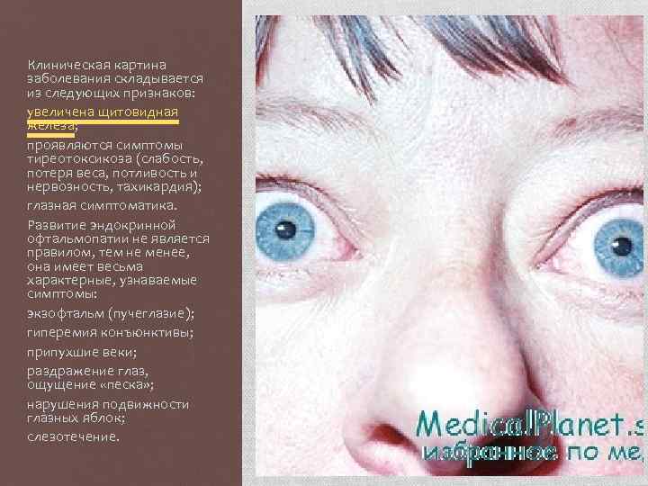 Клиническая картина заболевания складывается из следующих признаков: увеличена щитовидная железа; проявляются симптомы тиреотоксикоза (слабость,