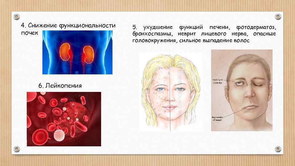 4. Снижение функциональности почек 6. Лейкопения 5. ухудшение функций печени, фотодерматоз, бронхоспазмы, неврит лицевого