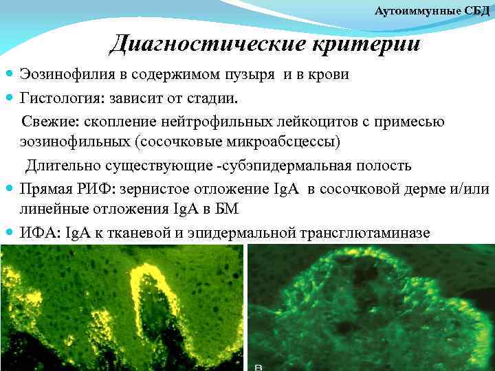 Аутоиммунные СБД Диагностические критерии Эозинофилия в содержимом пузыря и в крови Гистология: зависит от