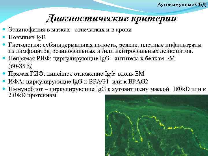 Аутоиммунные СБД Диагностические критерии Эозинофилия в мазках –отпечатках и в крови Повышен Ig. E