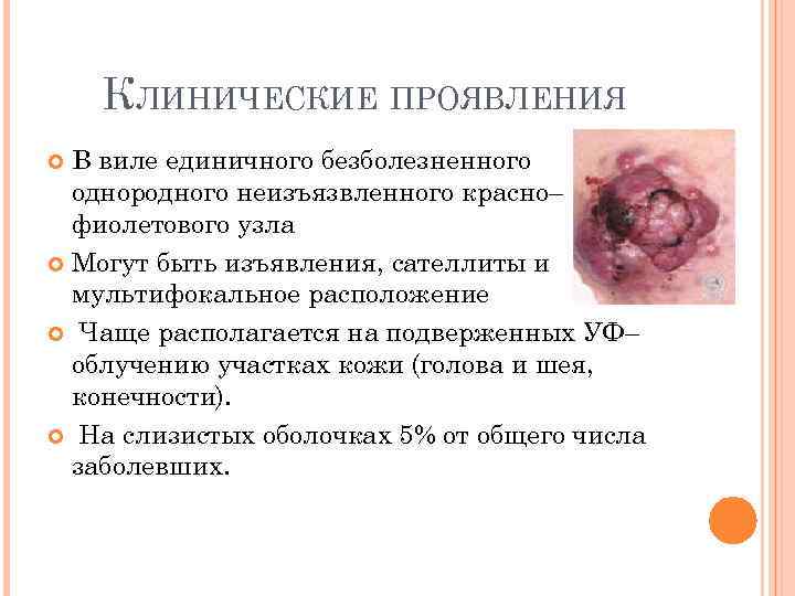 КЛИНИЧЕСКИЕ ПРОЯВЛЕНИЯ В виле единичного безболезненного однородного неизъязвленного красно– фиолетового узла Могут быть изъявления,