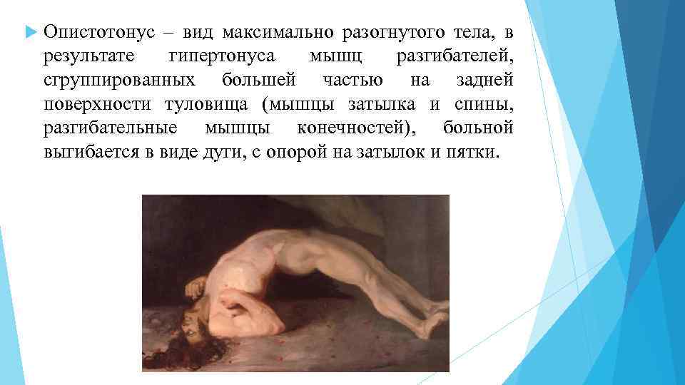  Опистотонус – вид максимально разогнутого тела, в результате гипертонуса мышц разгибателей, сгруппированных большей