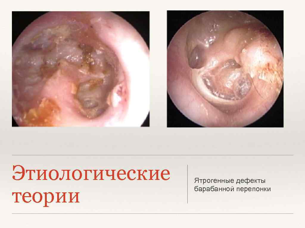 Этиологические теории Ятрогенные дефекты барабанной перепонки 