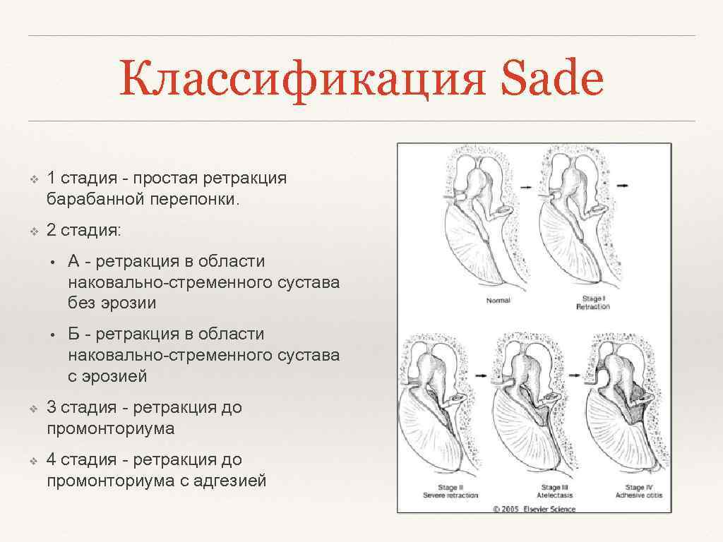 Классификация Sade ❖ 1 стадия - простая ретракция барабанной перепонки. ❖ 2 стадия: •